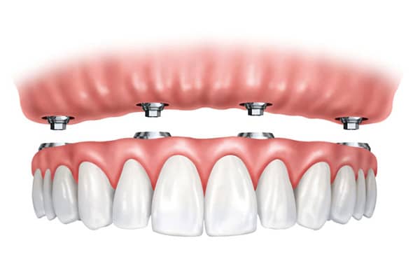 detrás Paquete o empaquetar captura ▷ Tipos de prótesis dentales | Clínica Dental Novadent
