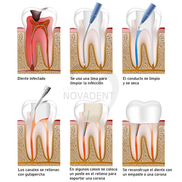 Presunción Senador asustado ▷ ¿Qué es una endodoncia? | Clínica Dental Novadent