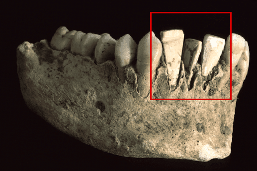implantes dentales mayas