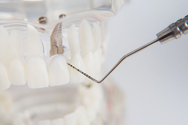 implantes dentales aspe