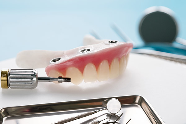 implantes dentales aspe