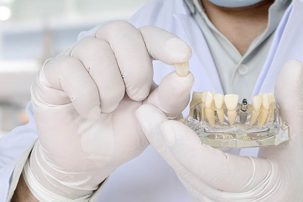 implantes dentales cuidados